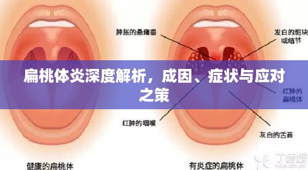 扁桃体炎深度解析，成因、症状与应对之策